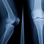 x ray